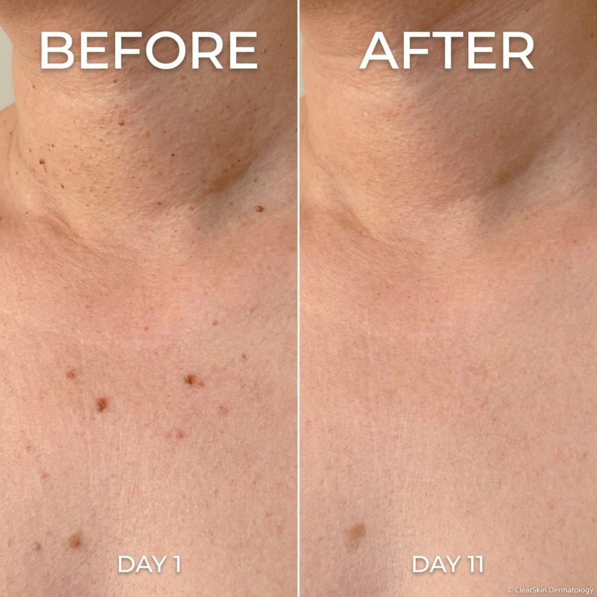 Sylvera Skin Tag Remover