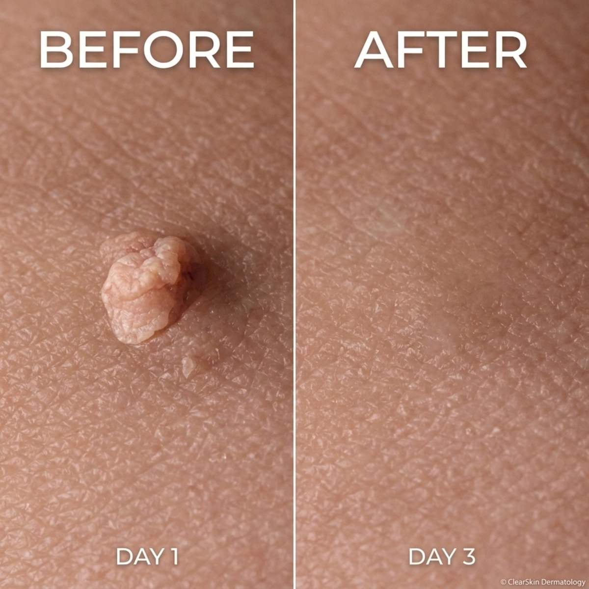 Sylvera Skin Tag Remover