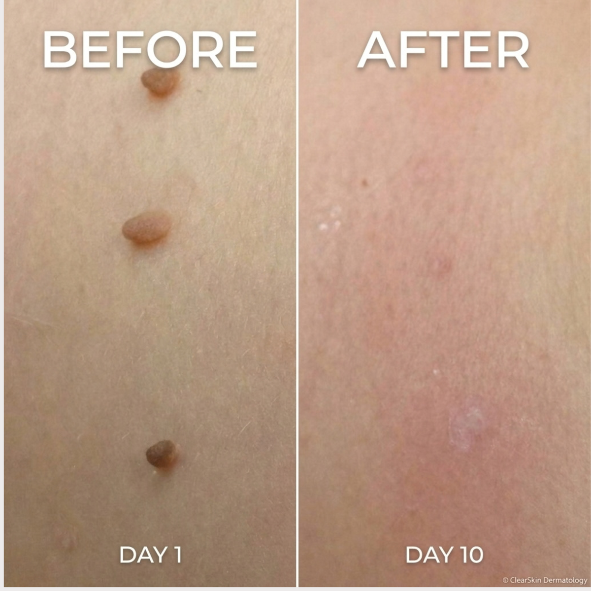 Sylvera Skin Tag Remover